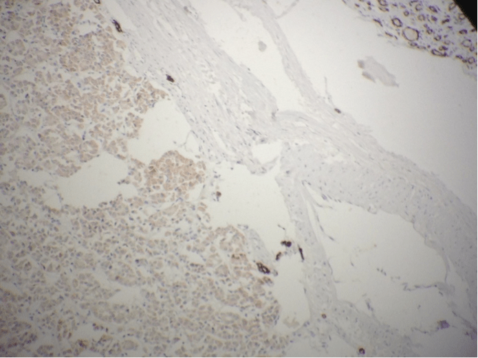 Oncocytome rénal avec implant péritonéal à propos d’un cas avec revue de littérature