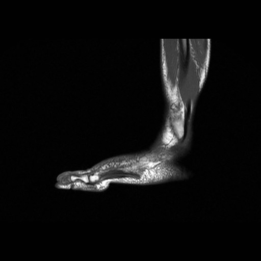 Acute osteomyelitis of the small toe