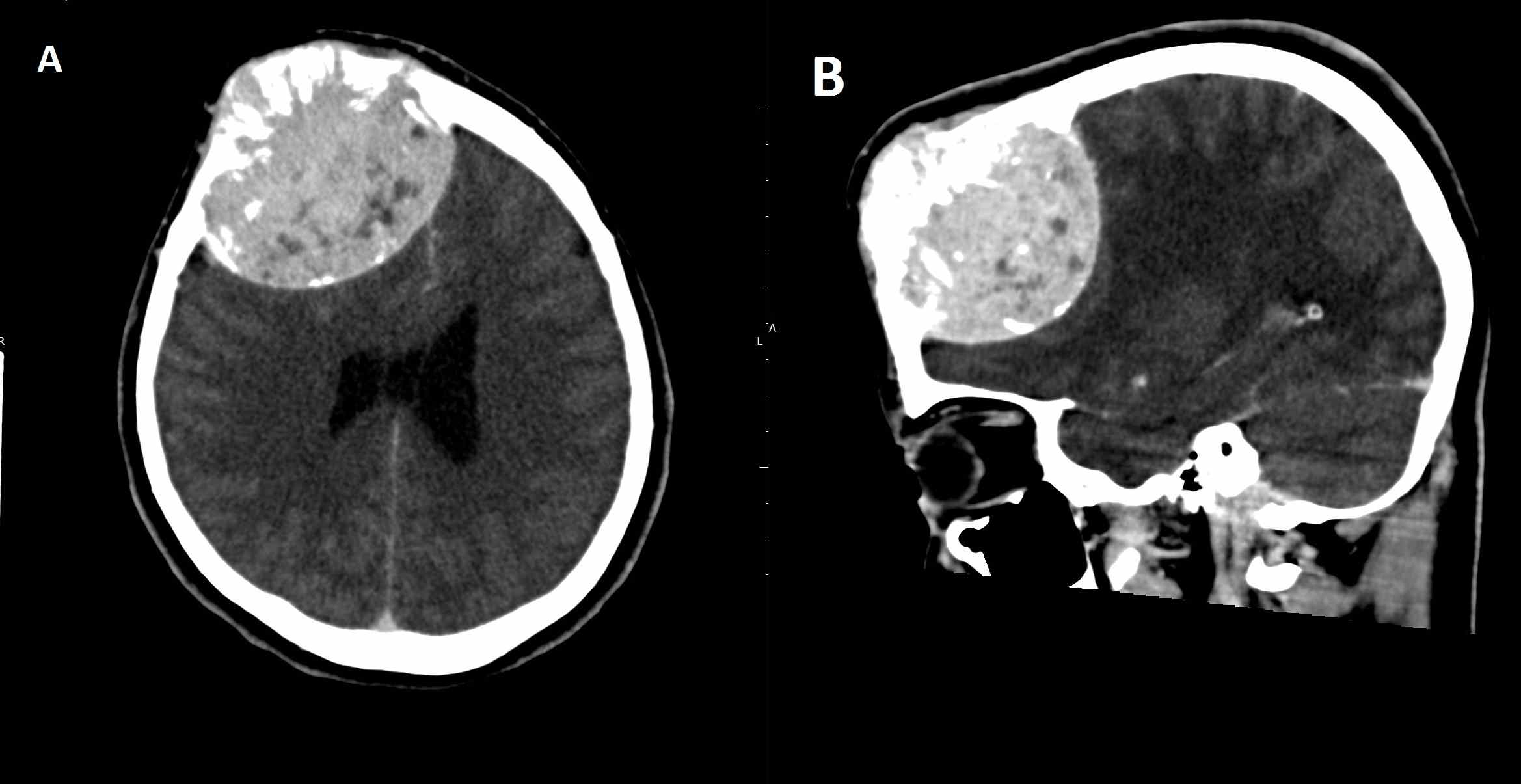 Skull and meningeal metastasis of papillary thyroid