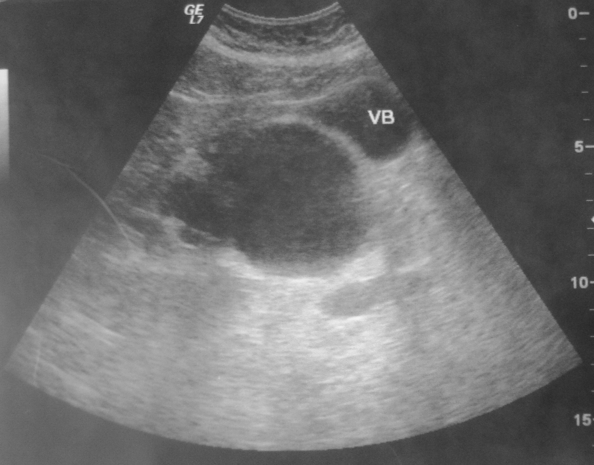Biliary cystadenoma causing obstructive jaundice