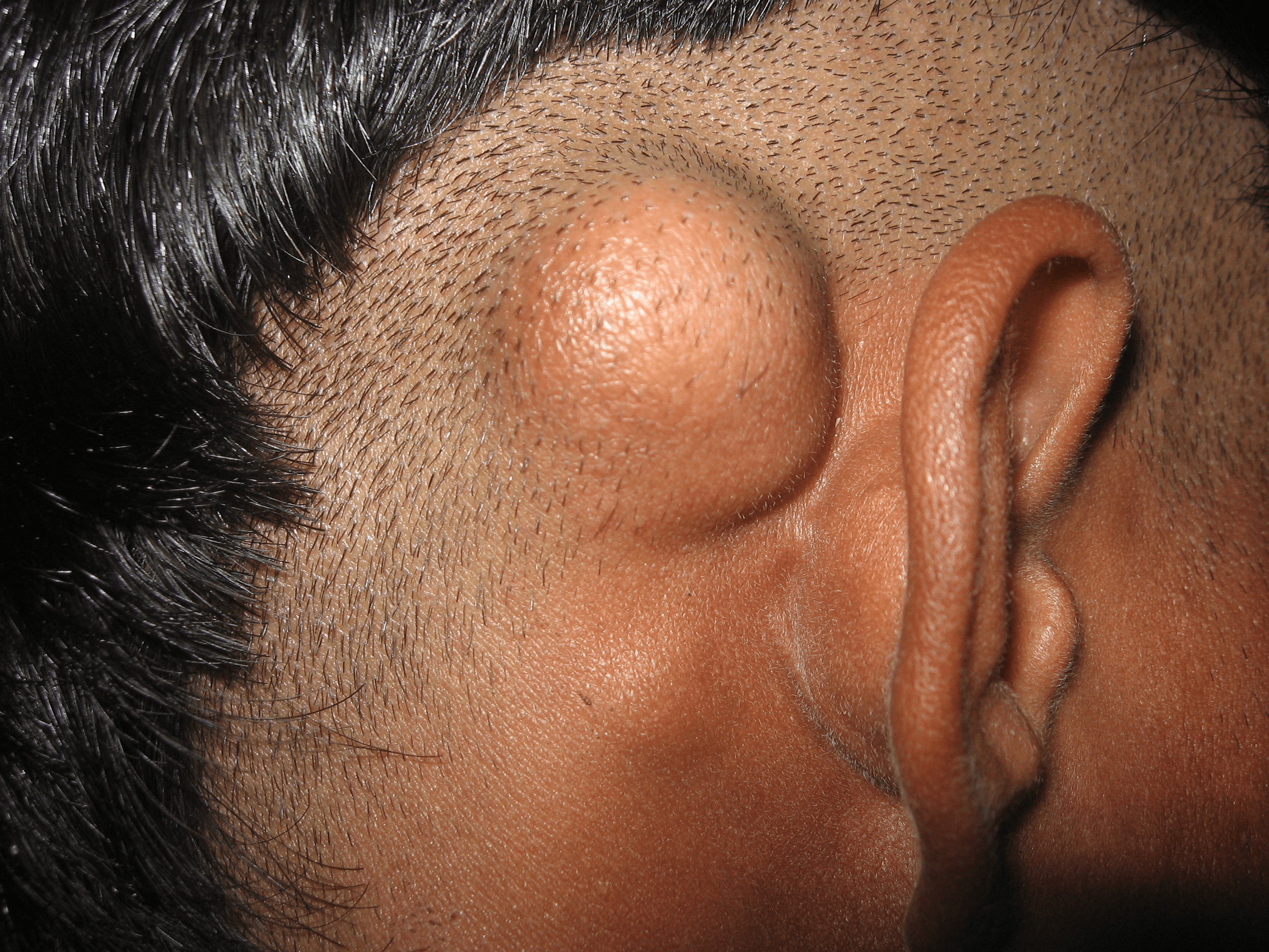 Mastoid Osteoma