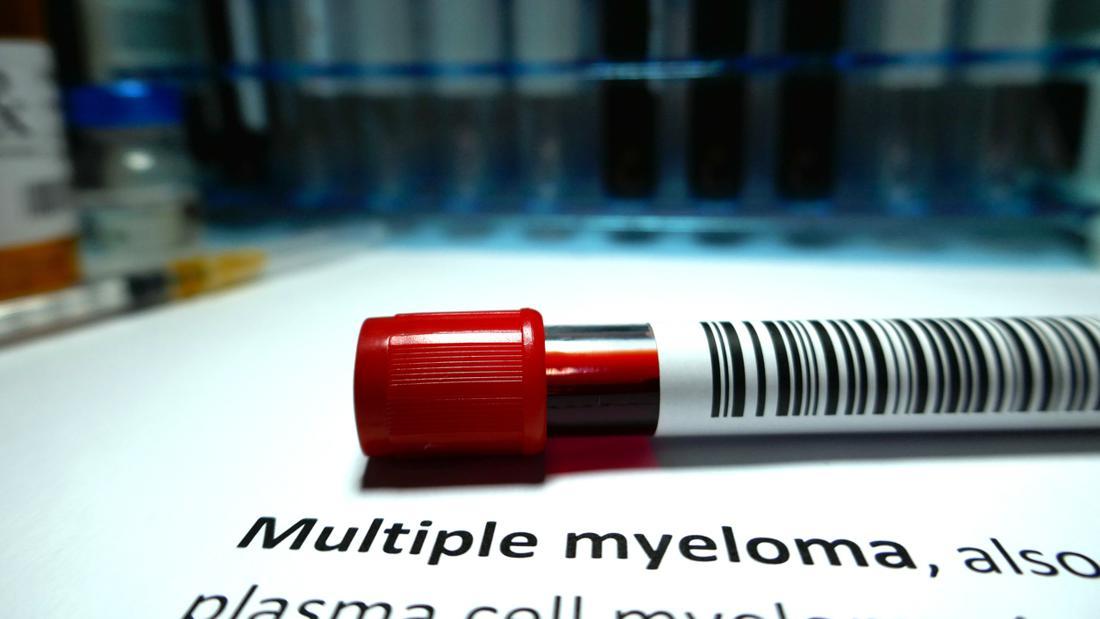 Sering Disangka Saraf Kejepit, Waspadai Gejala Kanker Multiple Myeloma