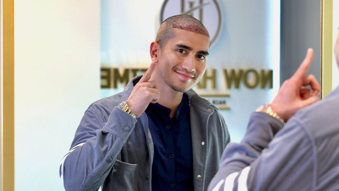 Verrell Bramasta Transplantasi Rambut, Sampai Pikirkan Kehalalan