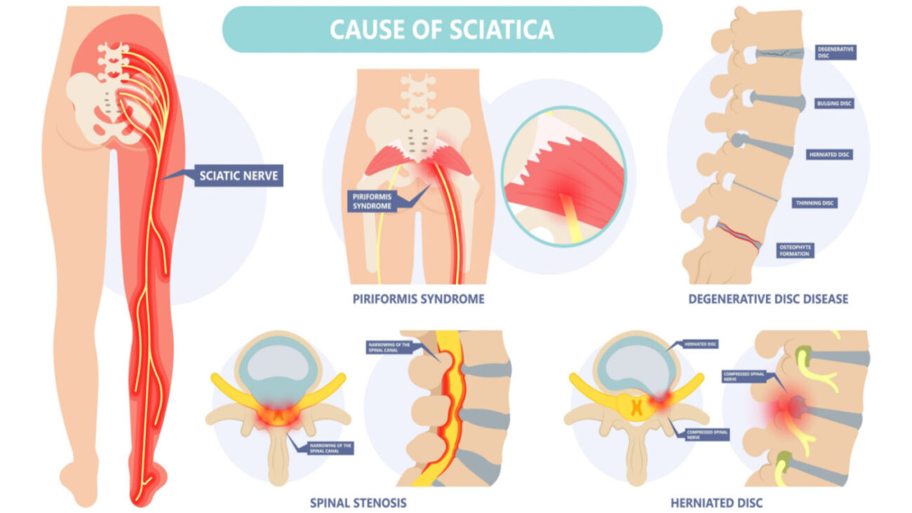 Sciatica in St. Louis Sciatica Treatment Near St. Louis Physical