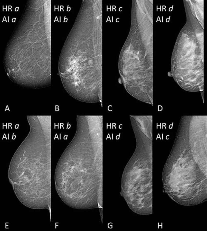 AI Provides Accurate Breast Density Classification Axis Imaging News