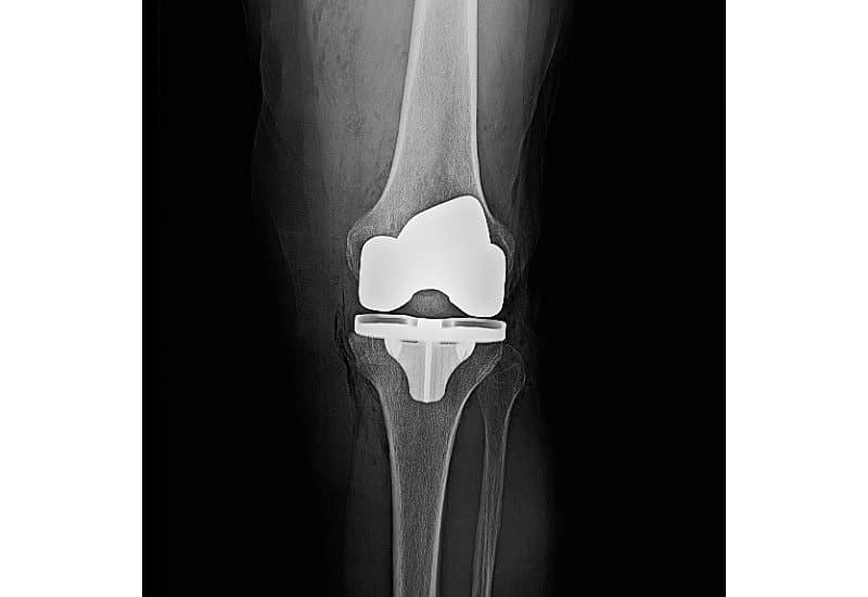 MRI Reveals Biologic Fixation of Knee Implant Axis Imaging News