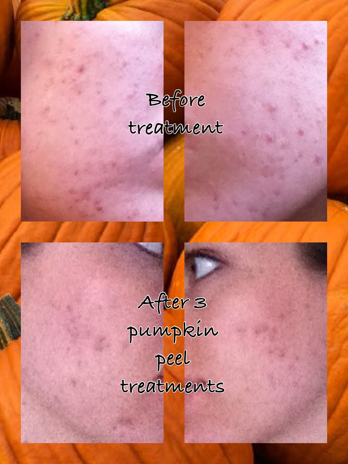 Pumpkin peel before and after photos Ayla Beauty's Blog
