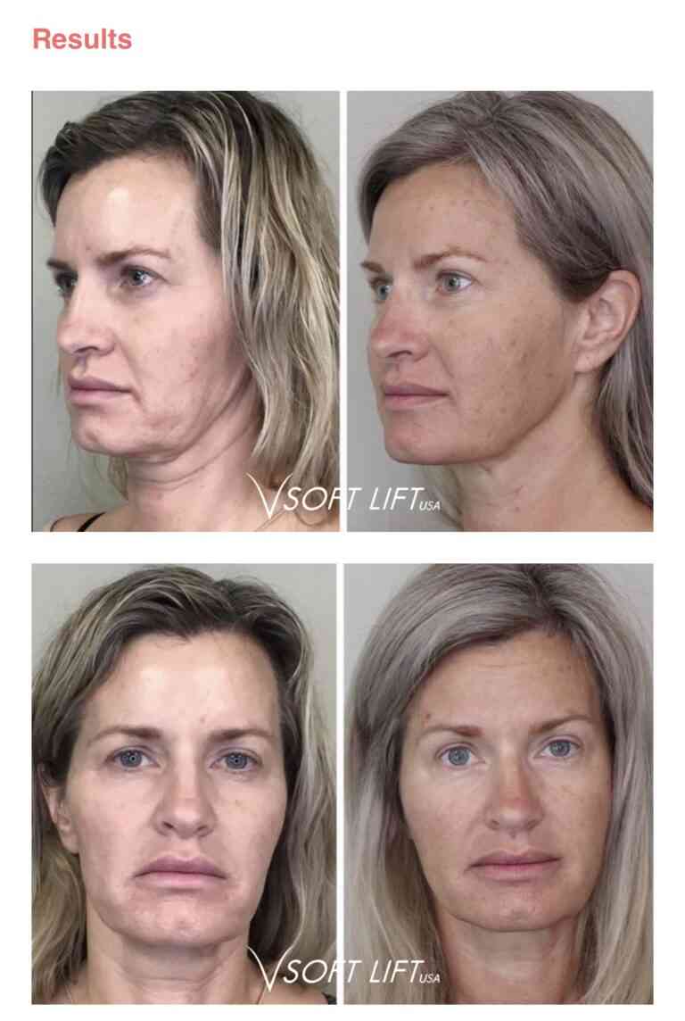 Face Lift PDO threads before and after Azani Medical Spa