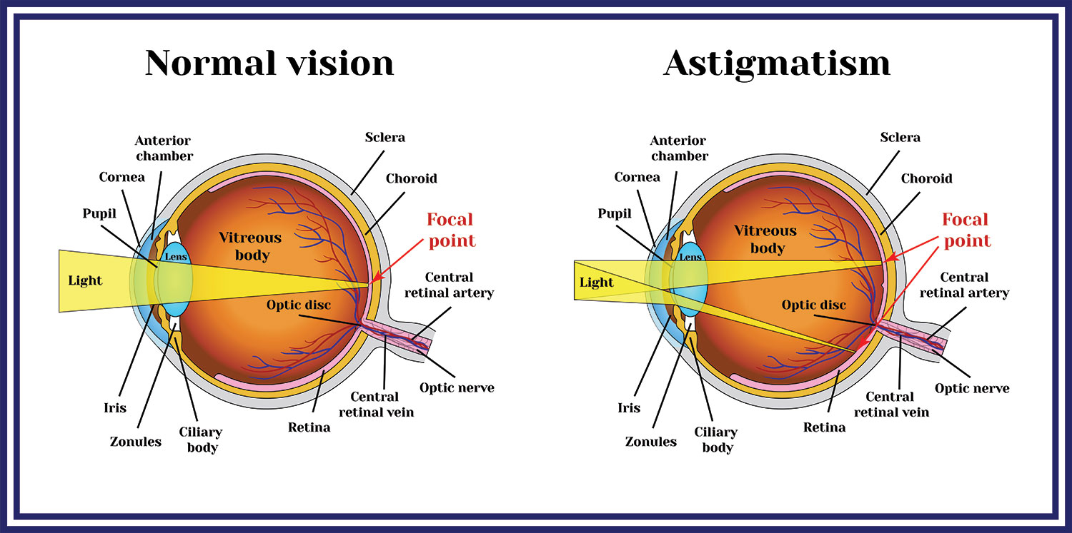 Refractive Errors Azar Eye Clinic