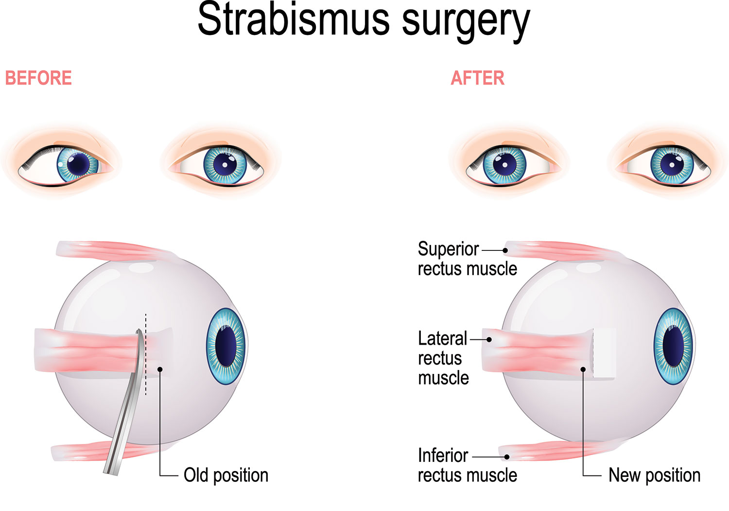 Strabismus and Amblyopia Azar Eye Clinic