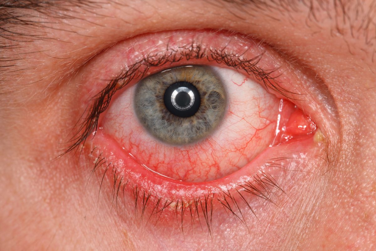 Inflammatory Eye Disease AZIV Infusion Therapy Center