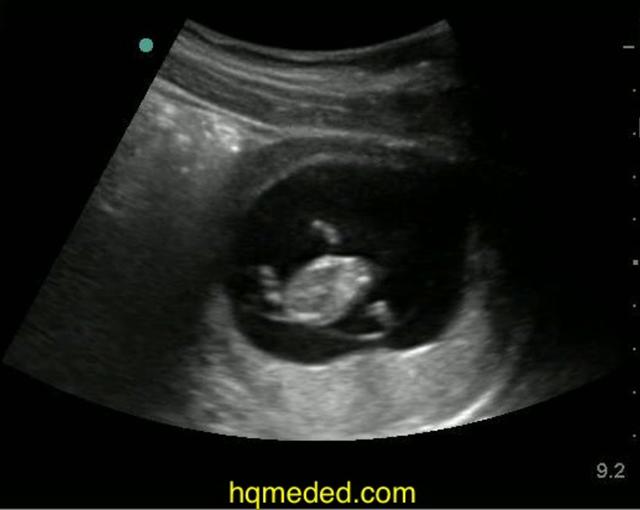 Ultrasonography intraperitoneal free fluid