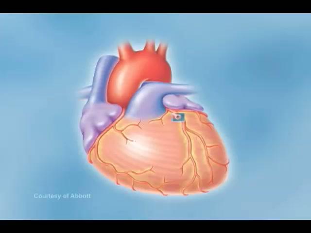 Anatomy of a Heart Attack Animation on Vimeo