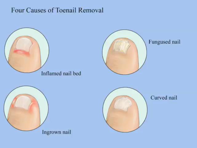 Nail Debridement Procedure Nail Ftempo