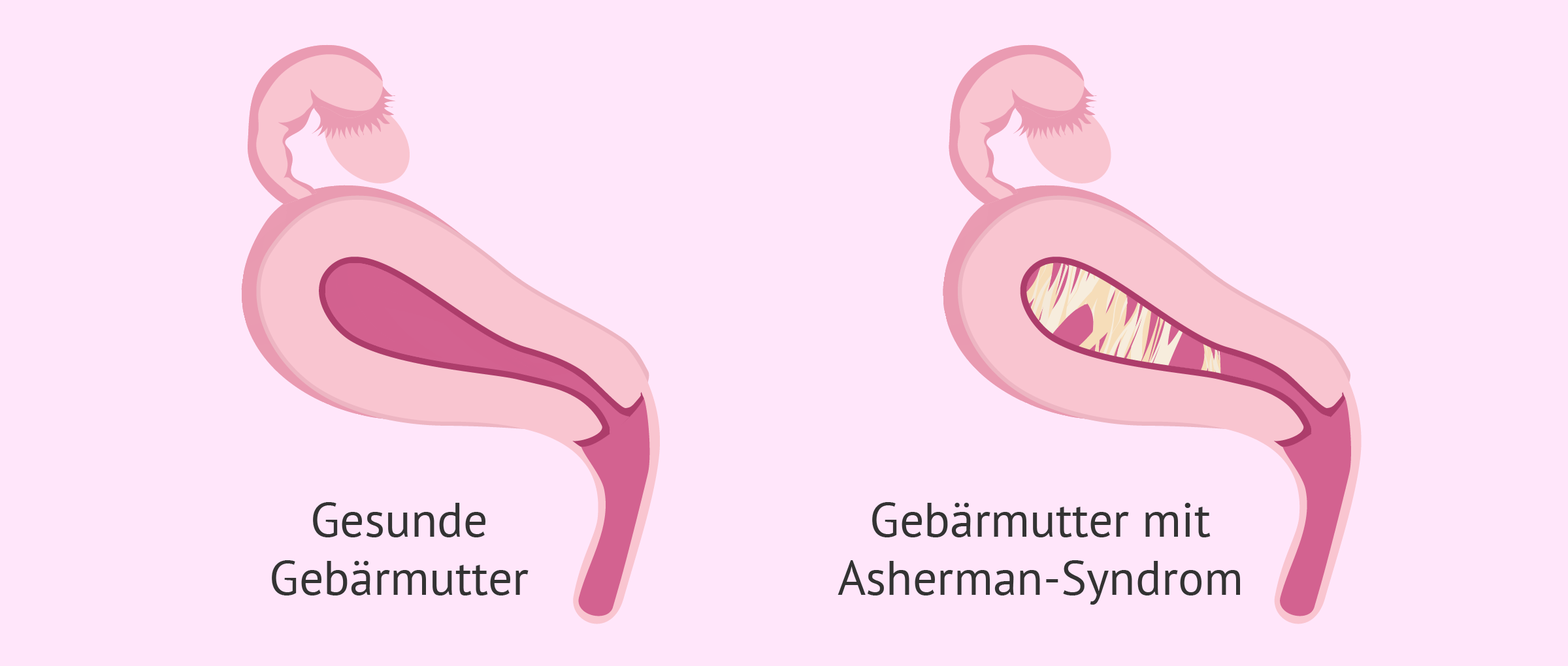 Gebärmutterschleimhaut Wie Hoch Bei Schwangerschaft Captions More