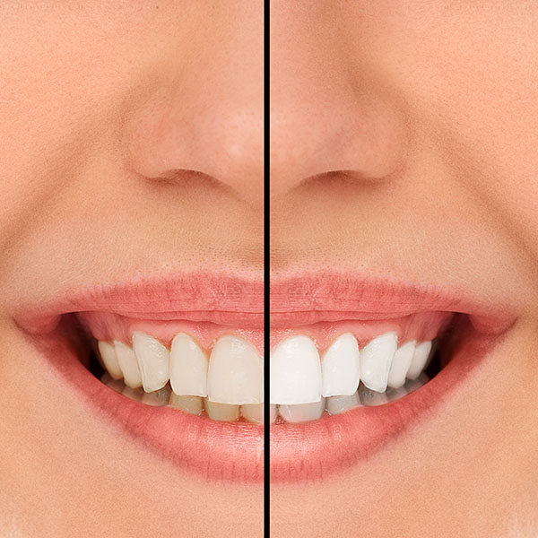 Learn About Professional Teeth Whitening Brands Edward Zeva D.M.D