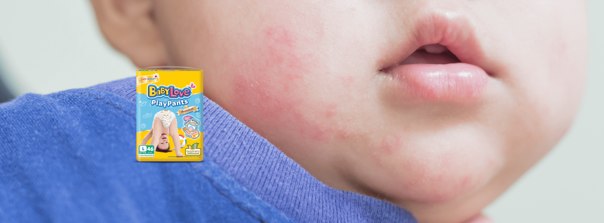 Baby Tips Baby Rash Parents’ Trouble Everyday