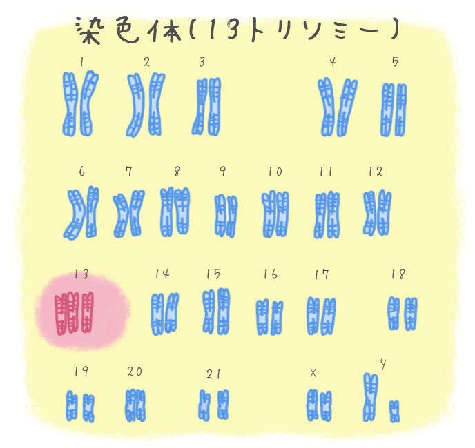 染色体異常の種類｜ダウン症やその他の染色体異常と特徴 ベビリナ