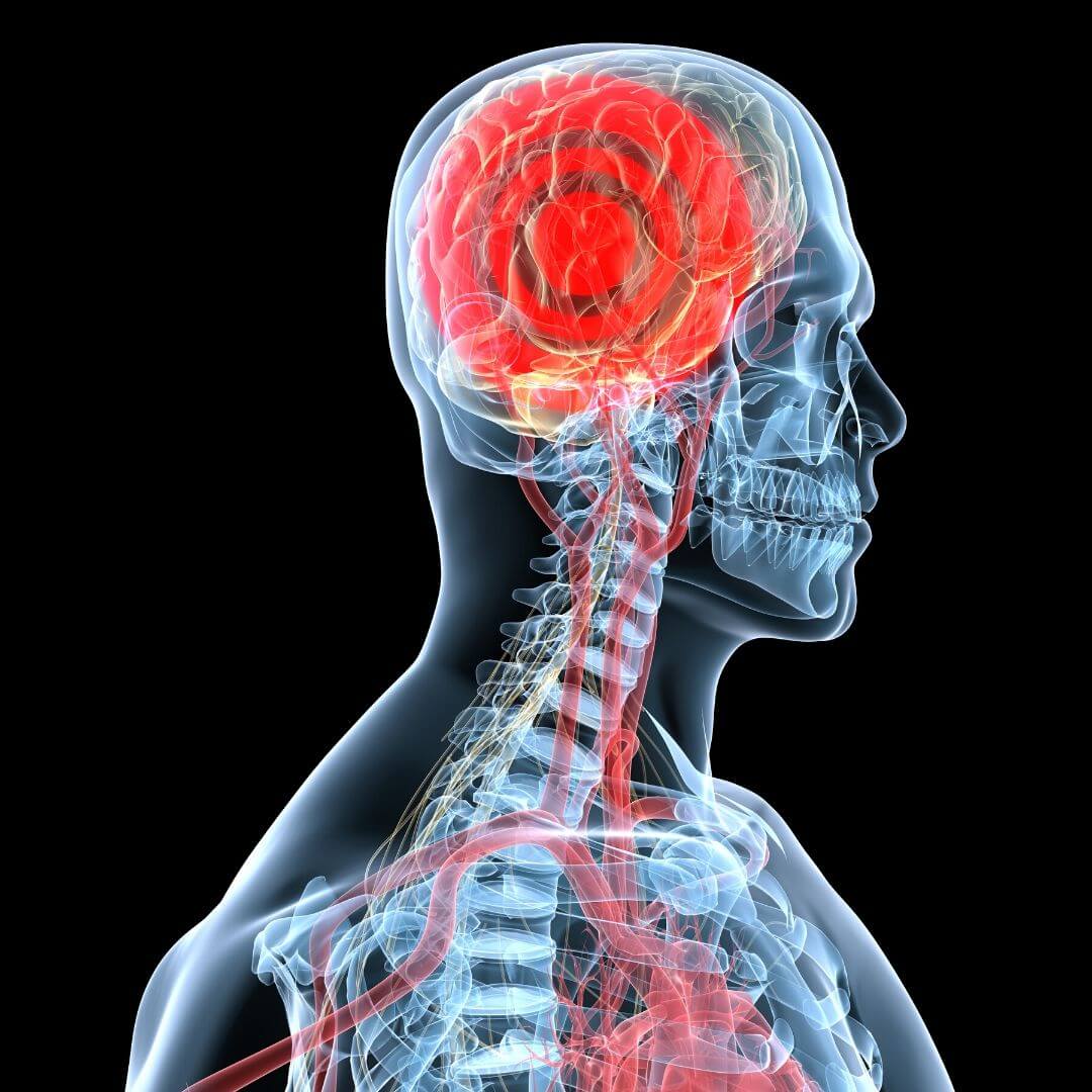 Acupuncture and Headaches Back At It Sports & Wellness