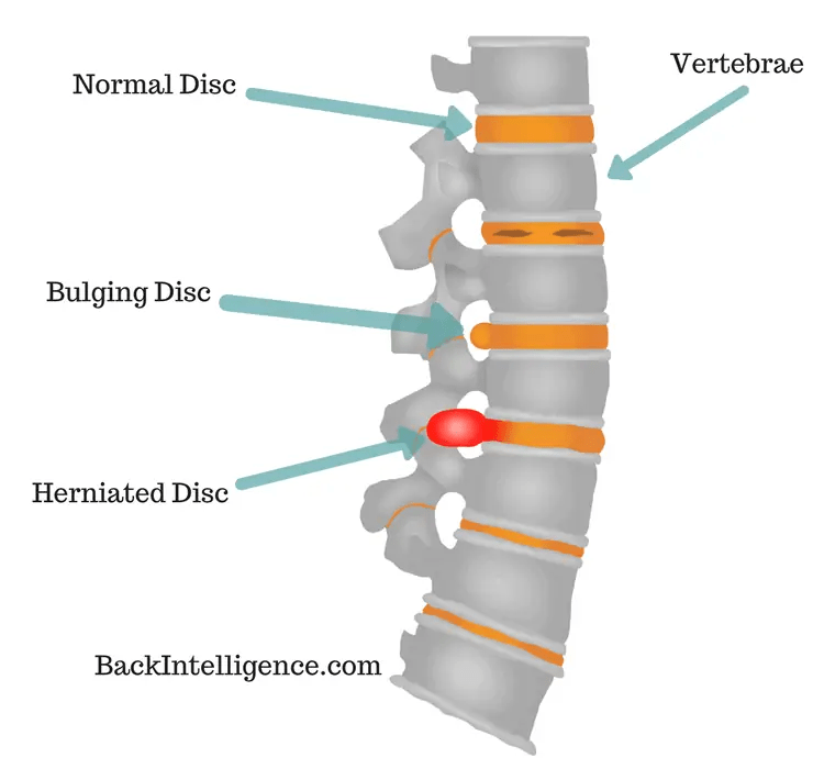 Lower Back Herniated Disc Exercises