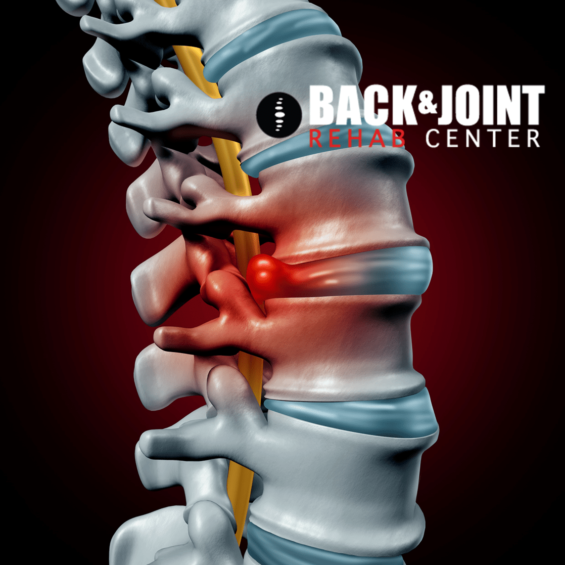 herniated disc, disc herniation, chiropractor, lower back pain, therapy