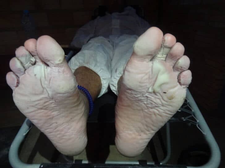 Maceration, Immersion Foot and Backpacking Backpacking Light