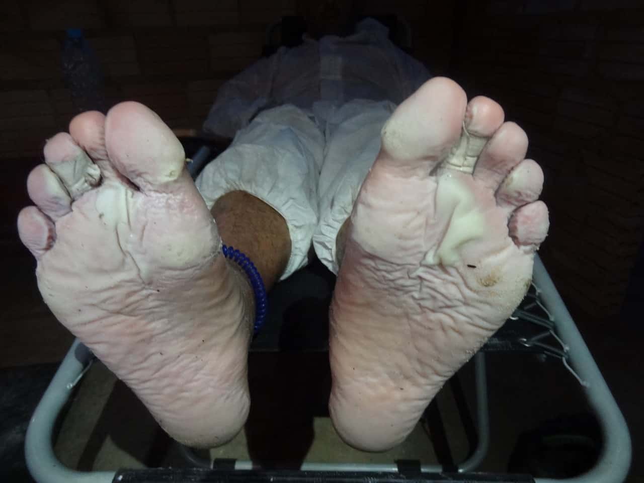 Maceration, Immersion Foot and Backpacking Backpacking Light