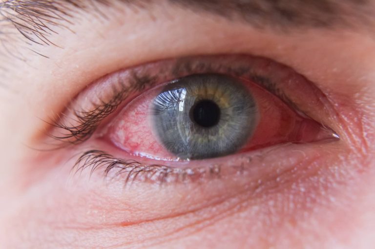 Why Do Eyes Burn in a Swimming Pool? Tips for Prevention and Relief
