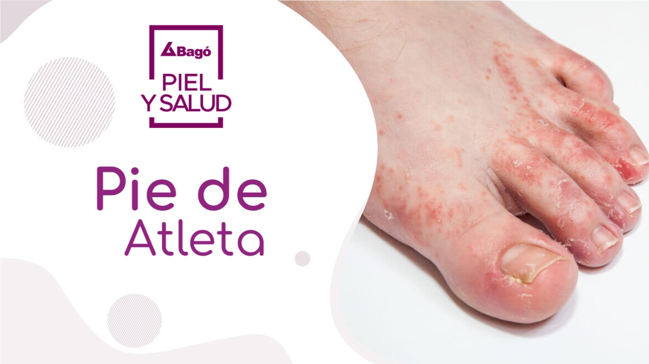 Pie de atleta Laboratorios Bagó