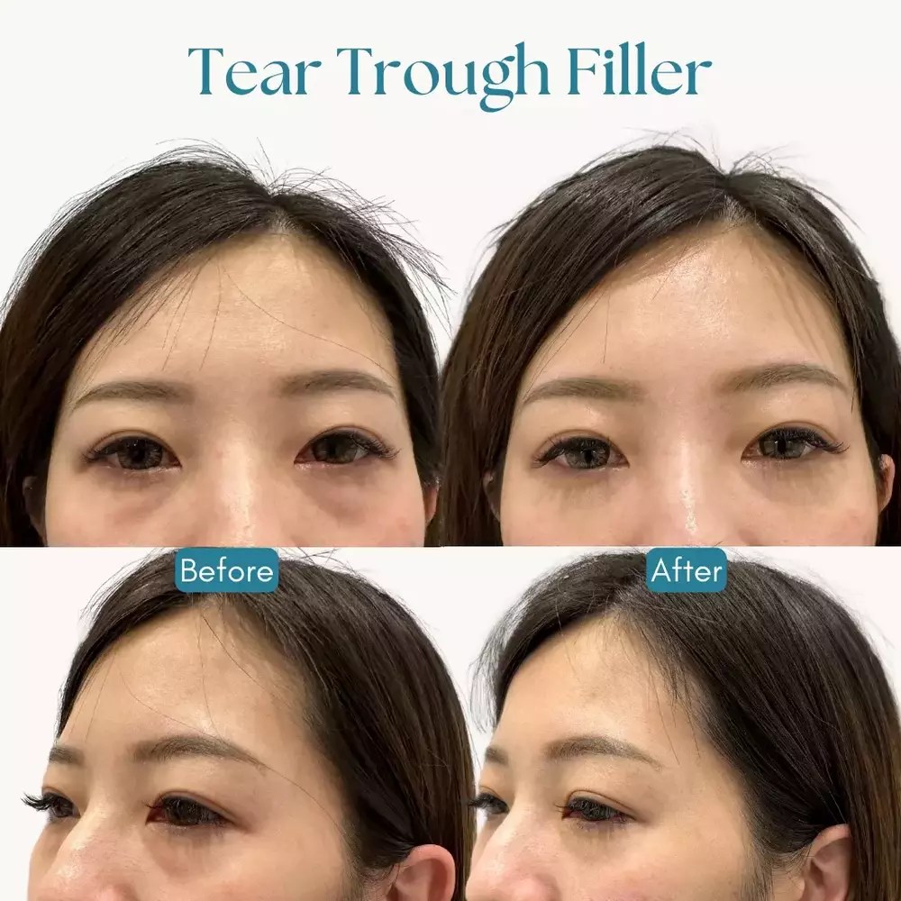 Tear Trough Filler Dark Circle Treatment BalaBala Laser Clinic