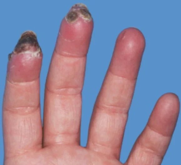 What is Raynaud’s Phenomenon?