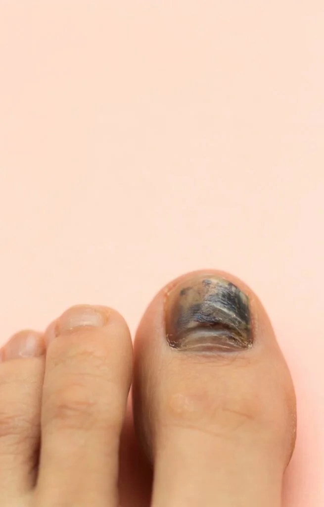 Unsightly Toenails and Fungal Infection Weil Foot & Ankle Institute