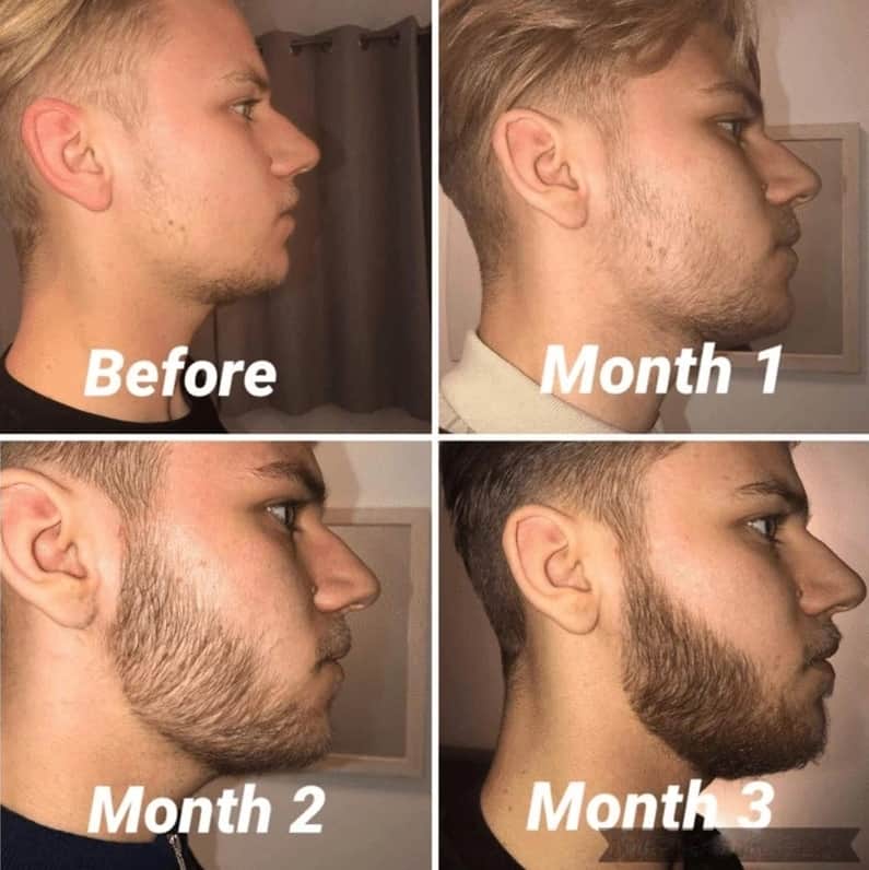 Beard Roller Activate New Growth (Microneedle) Bald & Beards