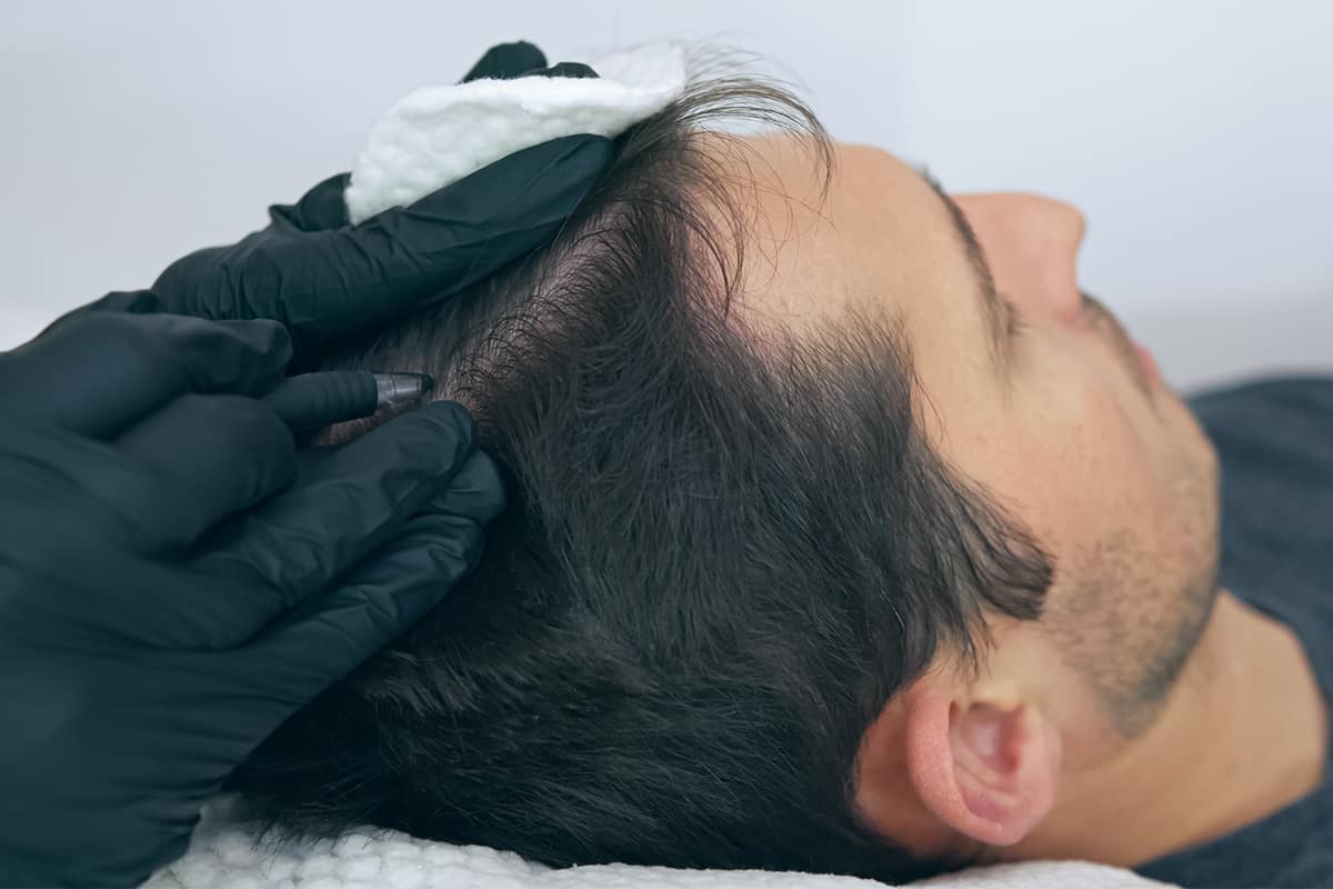 Scalp Micropigmentation Cost 5 Things to Know Bald & Beards