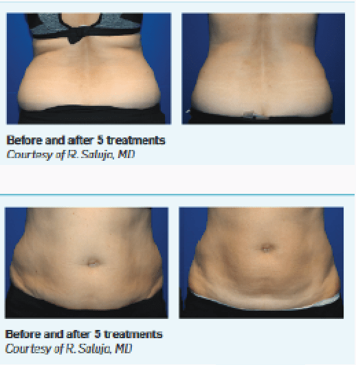 Flexsure Body Contouring in Foley, AL Baldwin GYN and Aesthetics