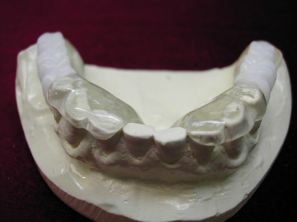 Digital Dental Implant Surgical Guides Baluke Dental