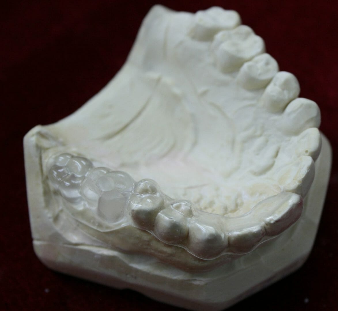 Digital Dental Implant Surgical Guides Baluke Dental