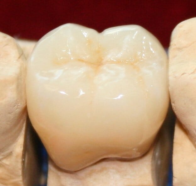 e.max® Pressed Crowns