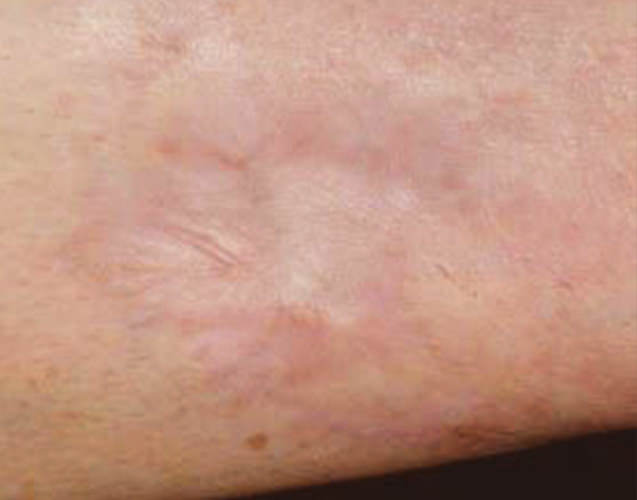 Laser Scar Removal Baratta Family Dermatology
