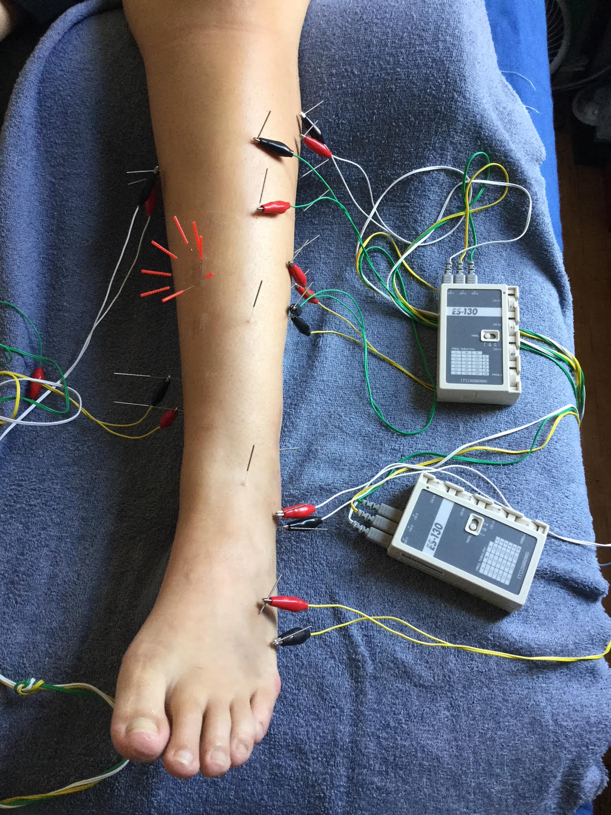 Sports Acupuncture Can It Benefit Strength Athletes? BarBend