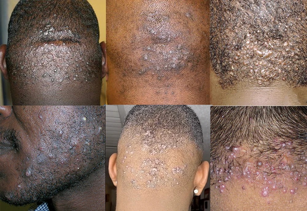 Ingrown Hair Treatment Understanding and Managing the Issue Barber