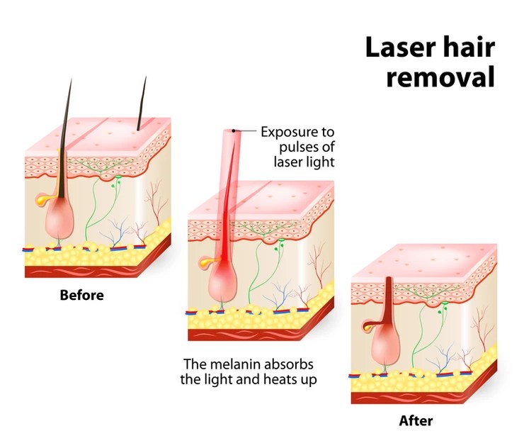 HOW DOES LASER HAIR REMOVAL WORK? Laser Spa In NYC