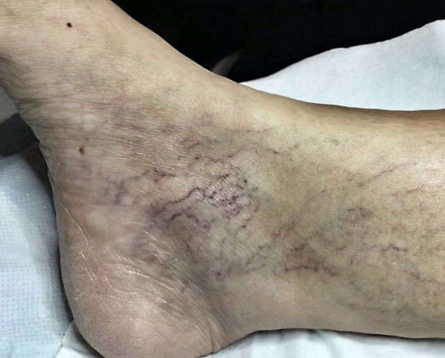 Laser Hair Removal Prices Bare UK Laser Hair Removal Oxford