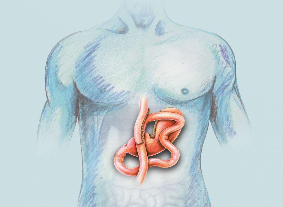 Difference between gastric bypass and mini gastric bypass? Upper GI