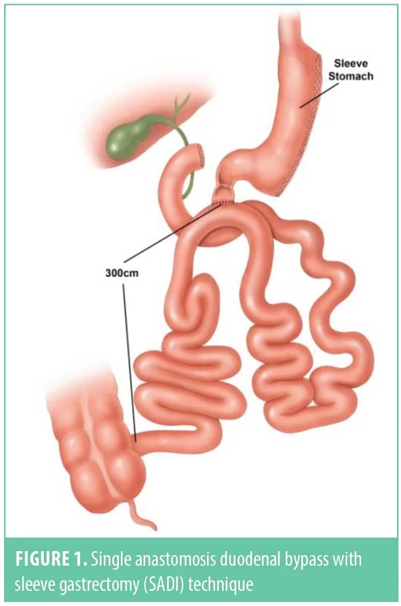 Leaks and Single Anastomosis Duodenoileal Bypass with Sleeve