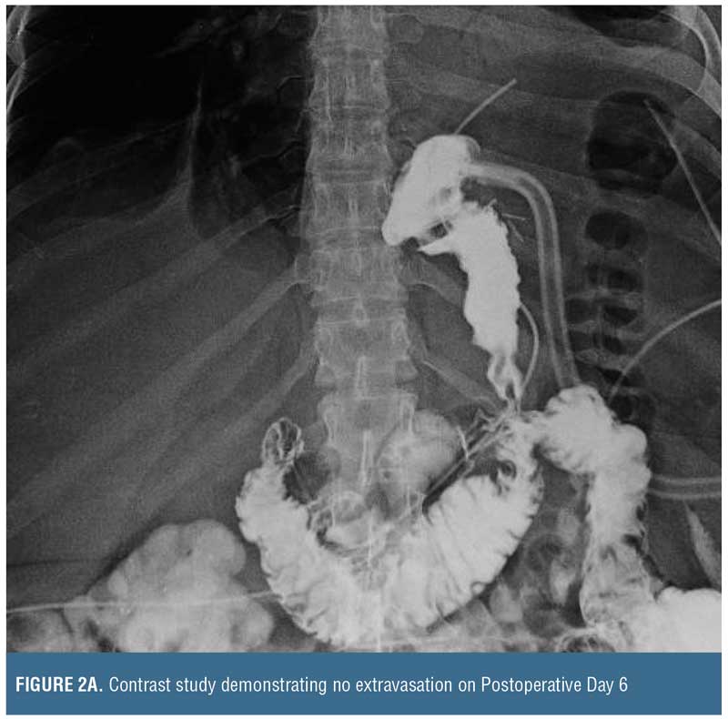 Tube Gastrostomy Management for Acute Sleeve Gastrectomy Leaks