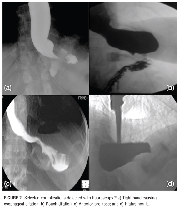 Gastric Band Adjustments Benefits of FluoroscopyGuided Adjustments