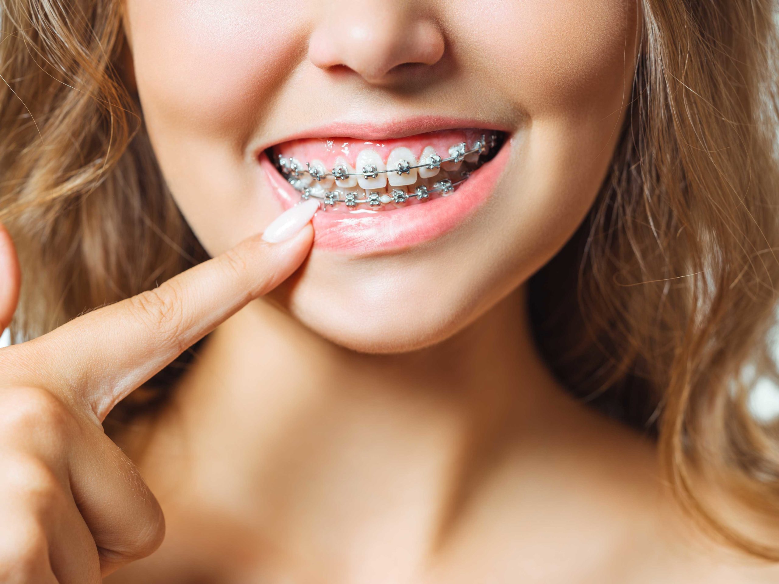 Orthodontics Braces Invisalign, Ceramic & Metal