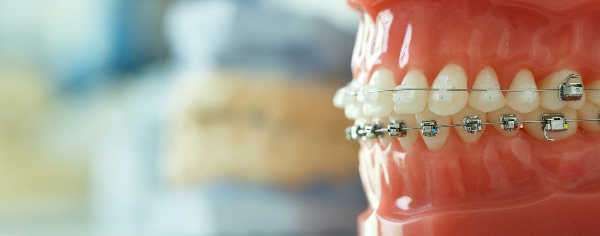 Explaining Underbites & Treating Underbites with Braces