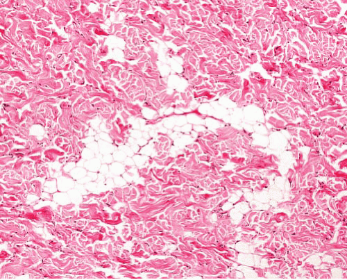 Benign and Intermediate Fibrosing Lesions Basicmedical Key
